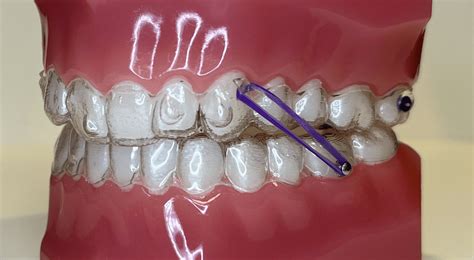 rubber bands invisalign braces